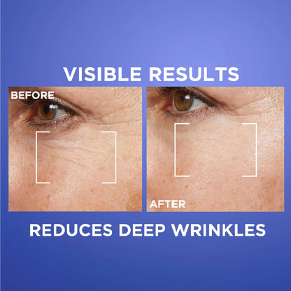 L'Oréal Paris, Revitalift Laser Retinol Deep Wrinkle Night Serum, With 0.2% Pure Retinol and Vitamin A, Targets all Wrinkles even Deep Ones, 30ml