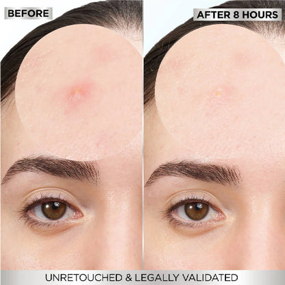 Garnier Skin Active Fast Clear Invisible Pimple Patch 8 Hours Hydrocolloid 22patches