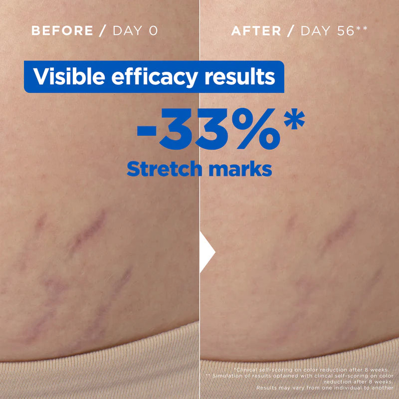 Mixa Anti Stretch Mark Oil - For Skin with Stretch Marks - With 30% Omega 6 & 9 - 100 ml